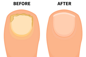 Fungal Nail Infection: Treatment, Causes, Medications & Picture