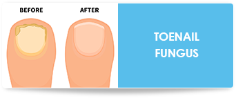 toenail fungus treatment in charlotte nc